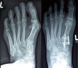 Röntgenbild Hallux valgus