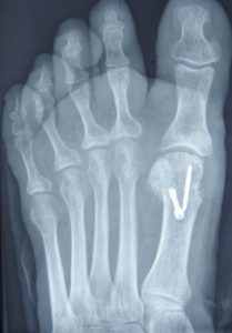 Röntgenbild Hallux valgus - nach der Operation